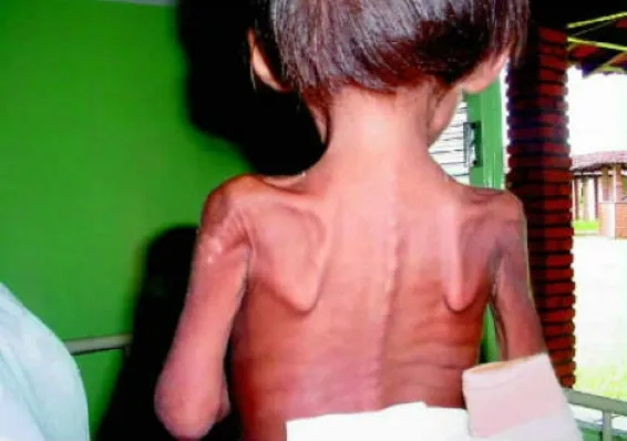 Evaluación médica y nutricional ante señales de marasmo infantil, pérdida de peso y alteraciones del crecimiento.